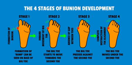 four-stage-bunion-development