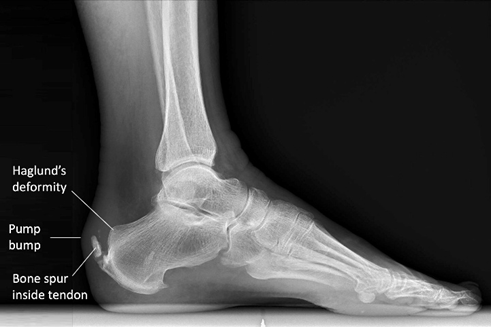 rxsurgicals-calcaneal-bursa-leading-to-achilles-tendinitis