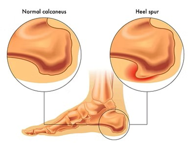 rxsurgicals-calcaneal-spur-and-plantar-fasciitis