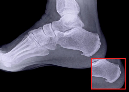 rxsurgicals-calcaneal-spurs-are-asymptomatic-and-pain