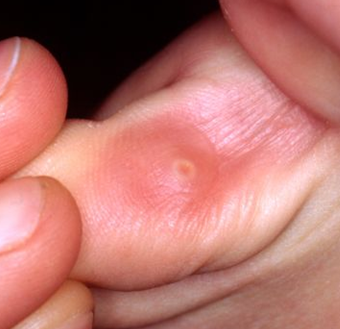rxsurgicals-callus-with-major-cause-being-foot-deformities