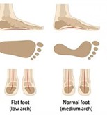 rxsurgicals-congenital-flat-foot