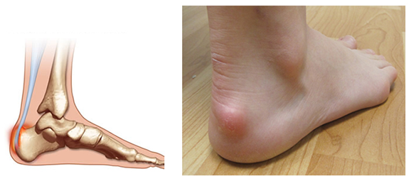 rxsurgicals-enlargement-of-the-bone-on-the-back-of-the-heel