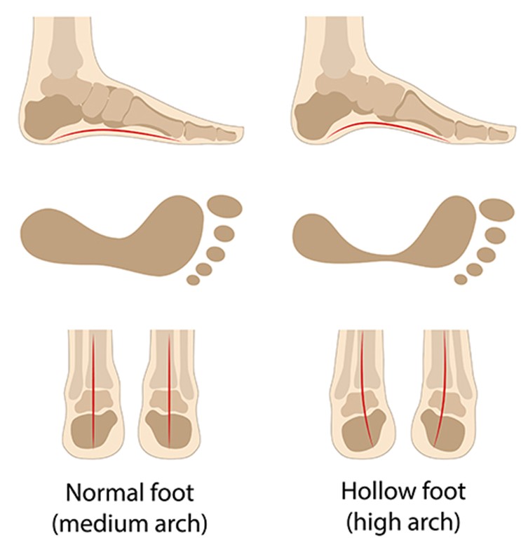 rxsurgicals-congenital-flat-foot
