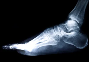rxsurgicals-know-about-calcaneal-spur-and-plantar-fasciitis