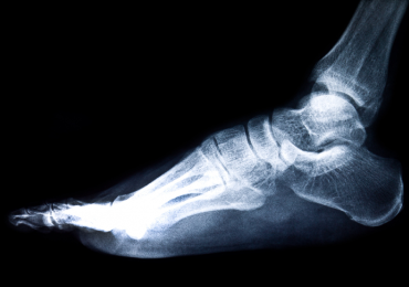 What you should know about Calcaneal Spur and Plantar Fasciitis