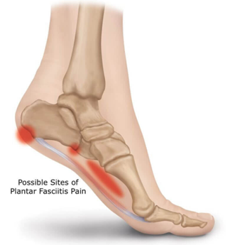 rxsurgicals-plantar-fasciitis-and-calcaneal-spurs