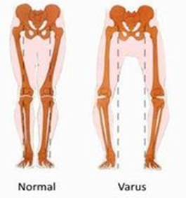 your-inner-ankle-bone-the-talus-is-sticking-out