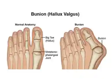 rxsurgicals_Bunion_Hallux_Valgus