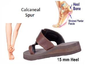 rxsurgicals-calcaneal-spur