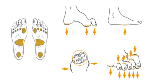 Areas-of-the-foot-that-are-more-prone-for-ulceration image