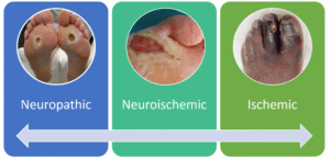 Diabetic foot ulcers
