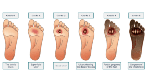 Diabetic ulcers grade image