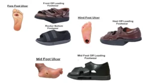 Diabetic foot ulcer