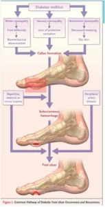 Common Pathway of Diabetic Foot Ulcer Occurrence and Recurrence.